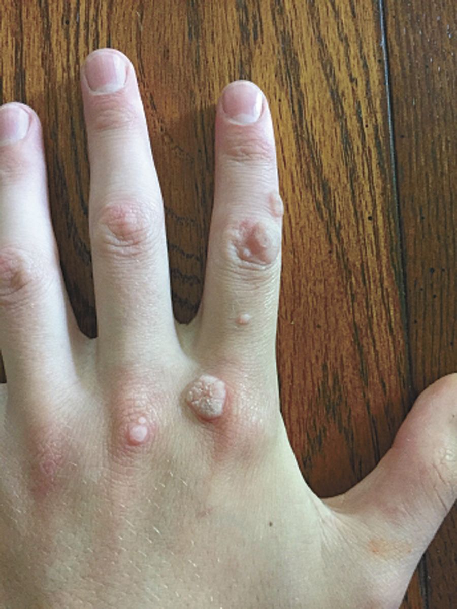wart farm tips magazine myself remover